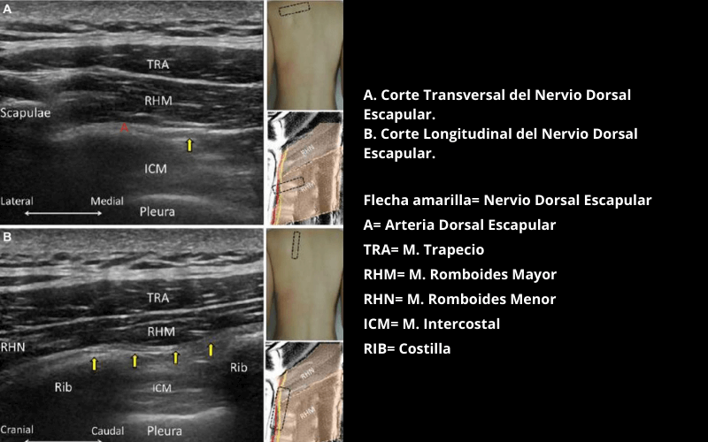 Nervio Dorsal Escapular (1).png